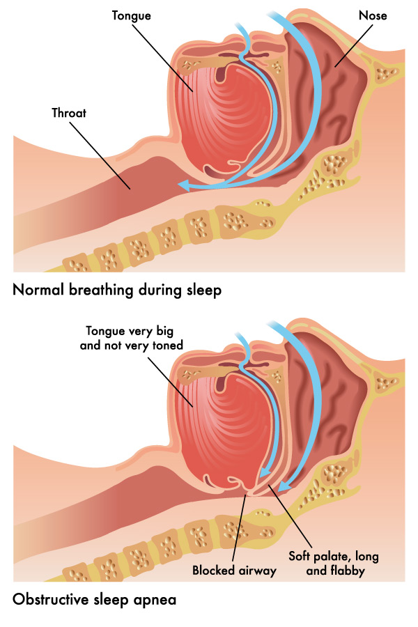 How sleep apnea occurs