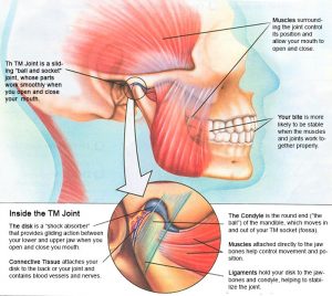 TMJ - strained jaw muscles and joints