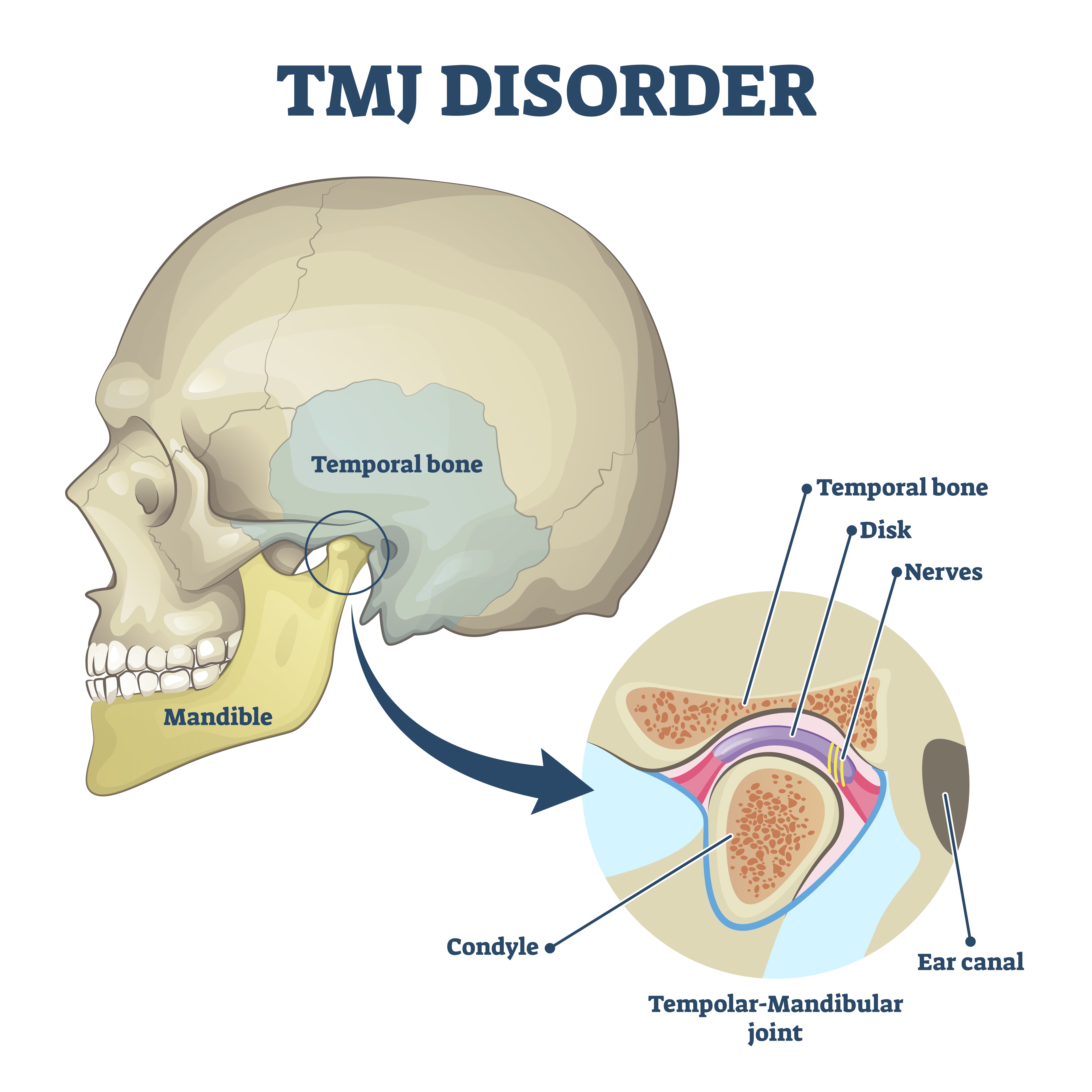 Diagram of a skull indicating the TMJ joint - TMJ Disorders