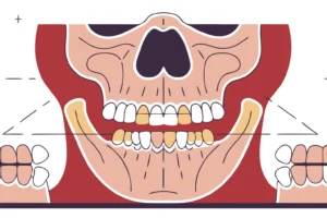 What Is TMJ Disorder? Causes, Symptoms, and Treatment Options